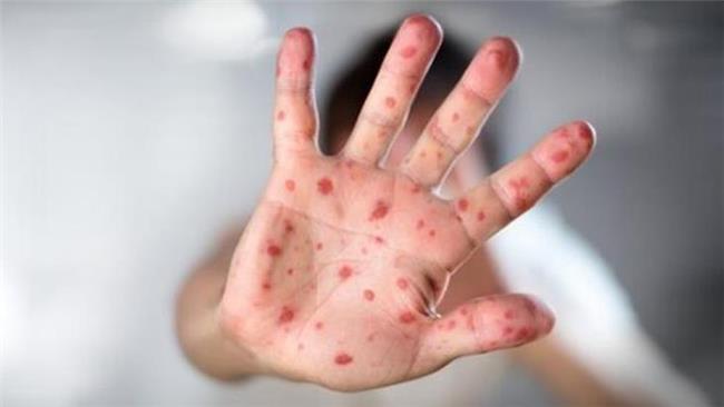 یک بیماری مرگبار دیگر در انتظار ایرانیان