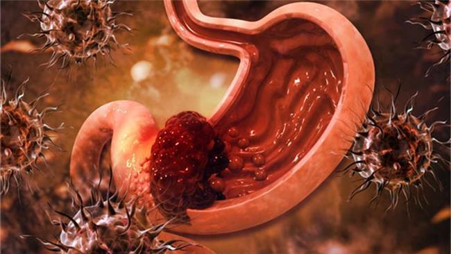 عوامل ابتلا به سرطان معده را بیشتر بشناسیم