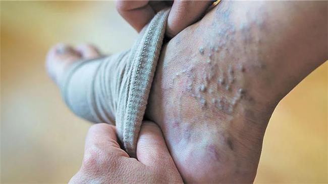 واریس؛ بیماری شایع اما قابل پیشگیری با چند عادت ساده