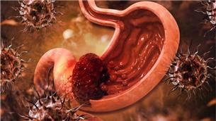 عوامل ابتلا به سرطان معده را بیشتر بشناسیم