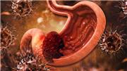 عوامل ابتلا به سرطان معده را بیشتر بشناسیم